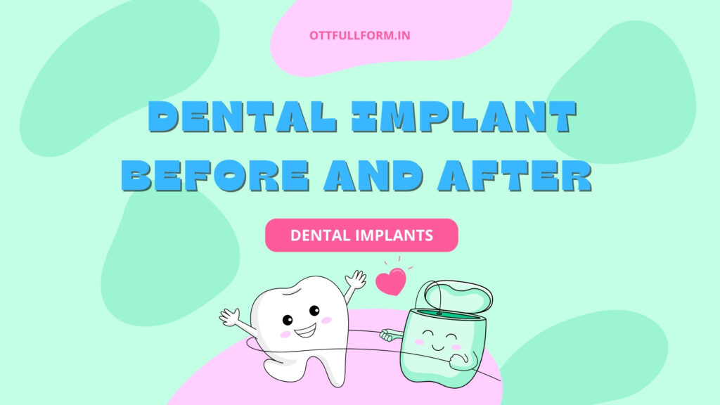 Dental Implants Before and After: Transforming Smiles and Lives