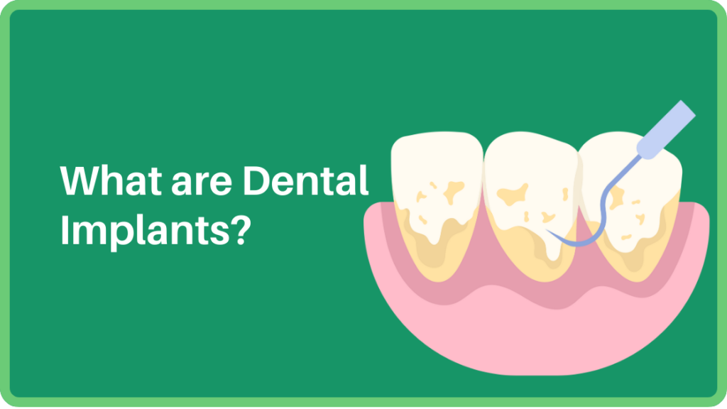 What are Dental Implants?