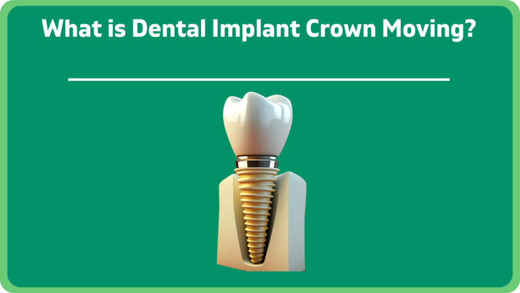 What is Dental Implant Crown Moving?
