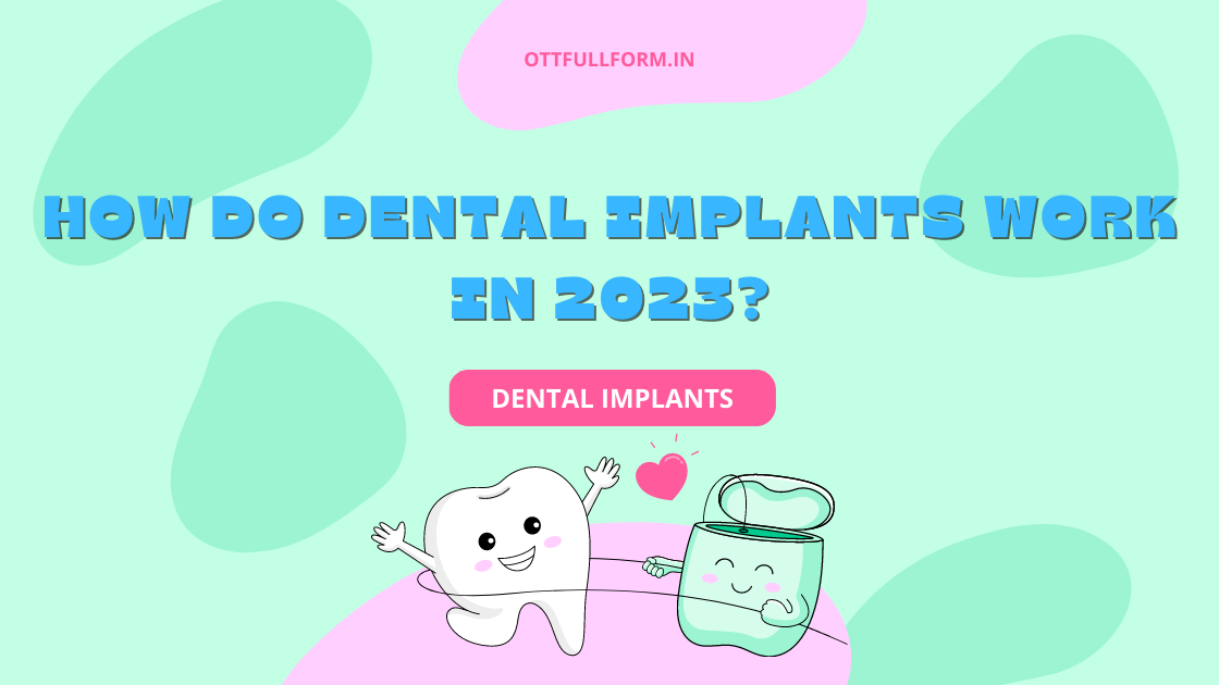 How Do Dental Implants Work in 2023?