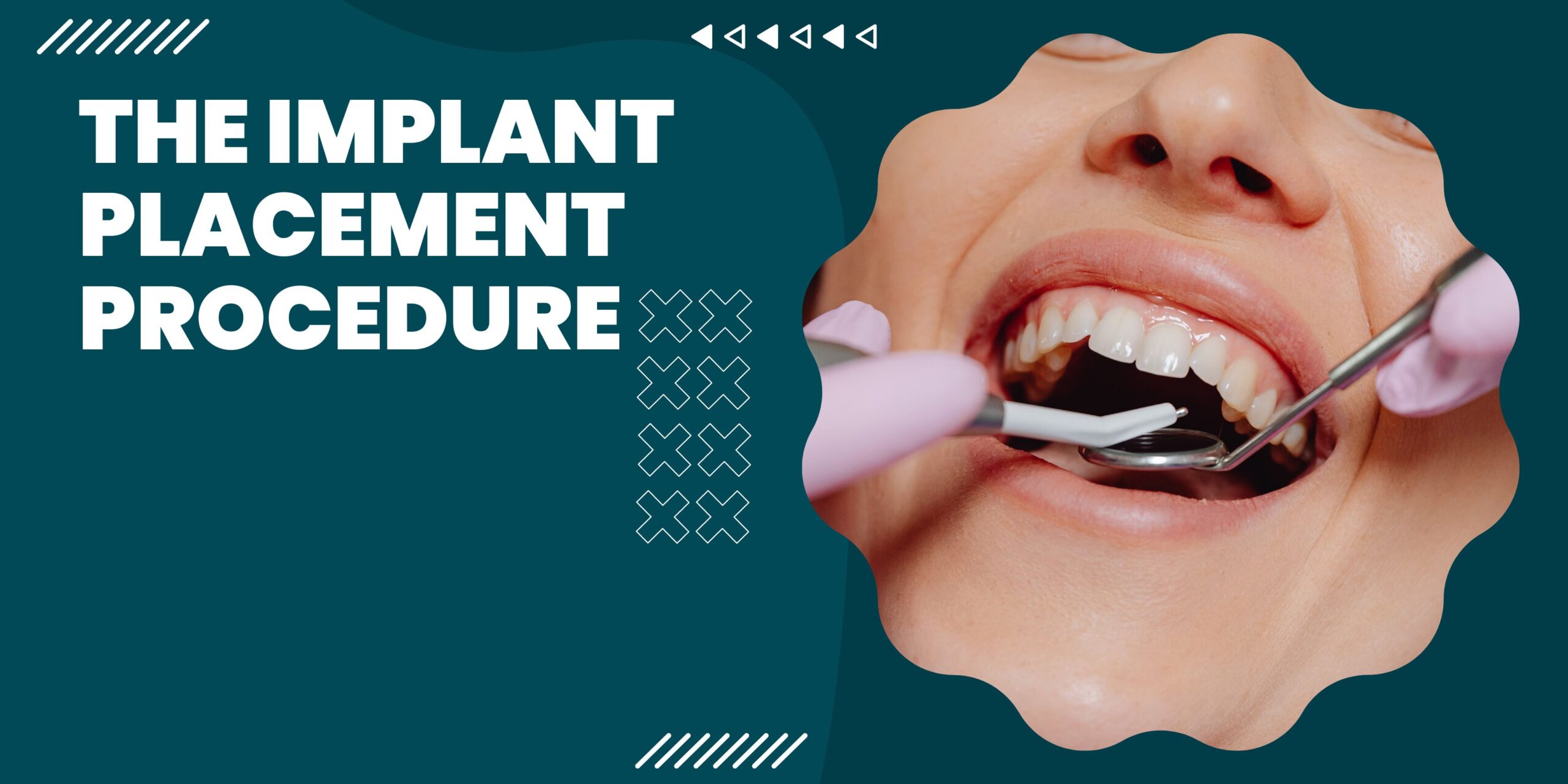 The Implant Placement Procedure